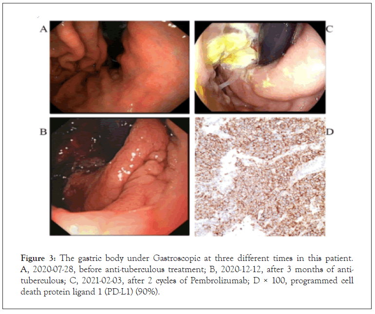 Gastroscopic