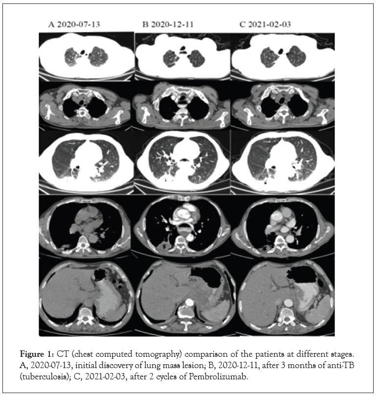 Pembrolizumab