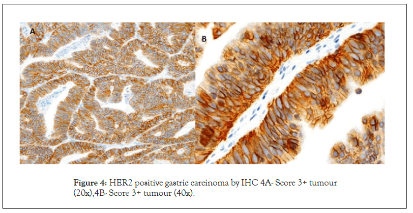 carcinoma