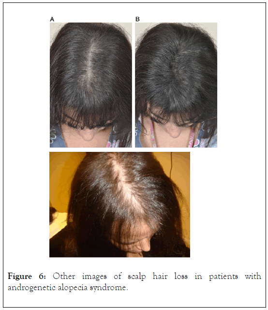 IGOA-scalp