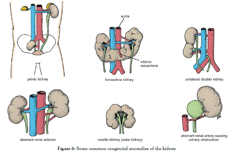 Kidney-anomalies-kidney