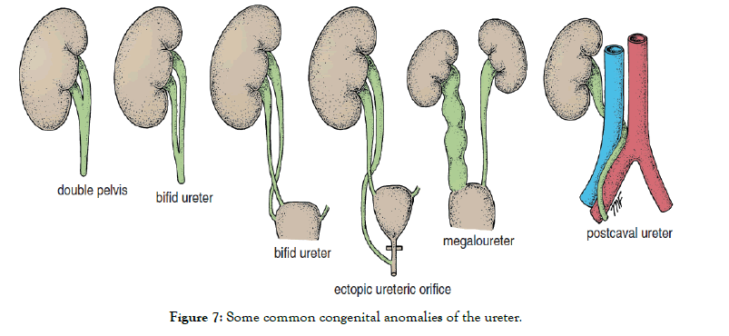 Kidney-anomalies-ureter