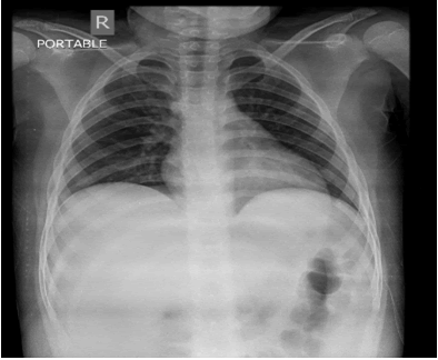 Pediatrics-Therapeutics-Chest