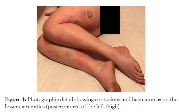 alcoholism-and-drug-dependence-haematomas