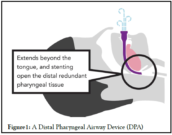anesthesia-clinical-Pharyngeal