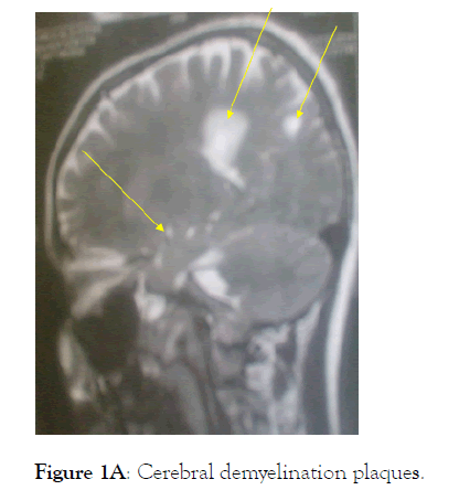 anesthesia-clinical-demyelination