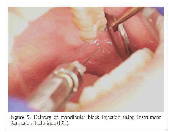 anesthesia-clinical-mandibular