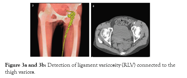 angiology-ligament