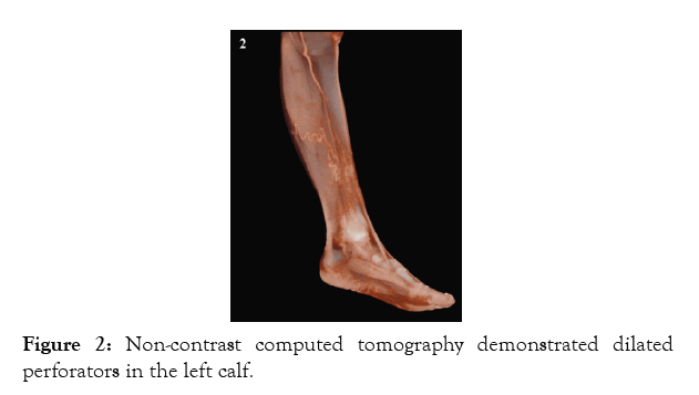 angiology-perforators