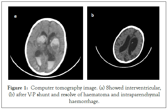 antivirals-antiretrovirals-haematoma