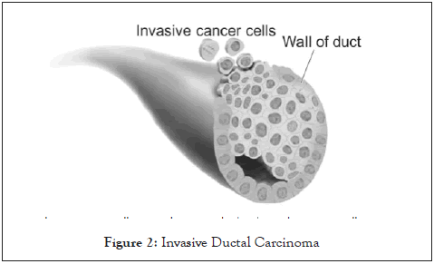 Carcinoma