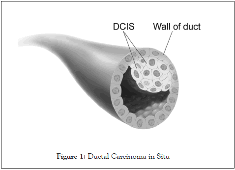 Ductal