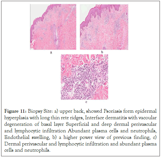 Psoriasis