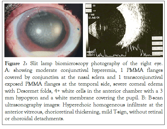 conjunctival