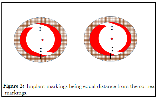 corneal