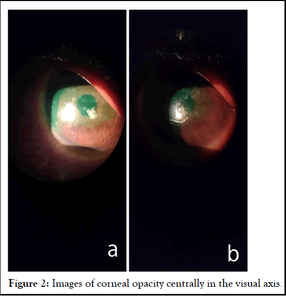 corneal