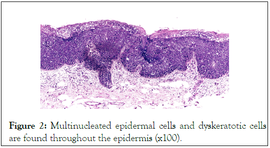 dyskeratotic