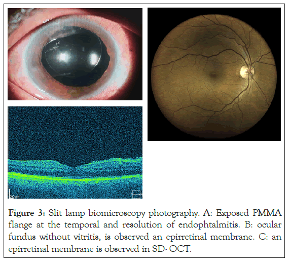 endophtalmitis