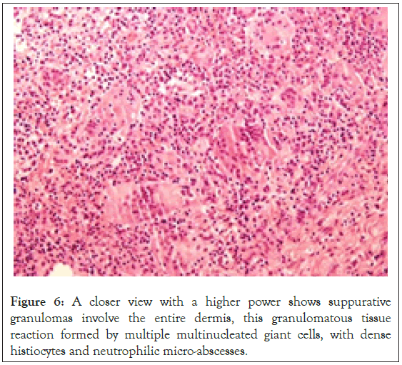 neutrophilic