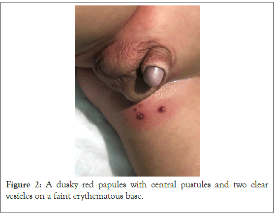 papules