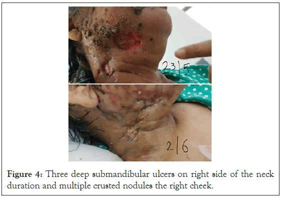 submandibular