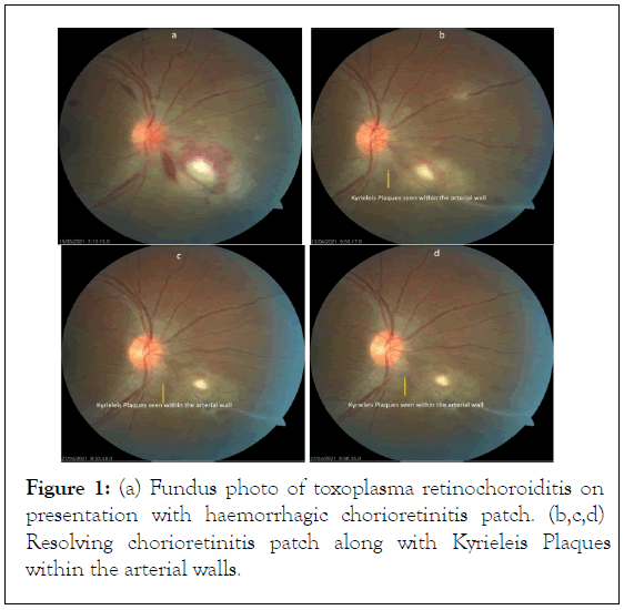 toxoplasma