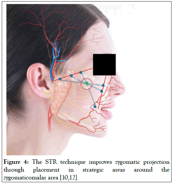 zygomatic