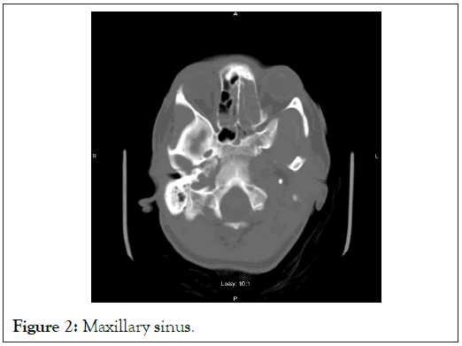 Maxillary