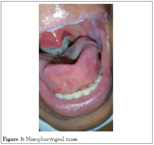 Nasopharyngeal