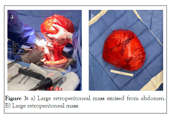 clinical-trials-retroperitoneal