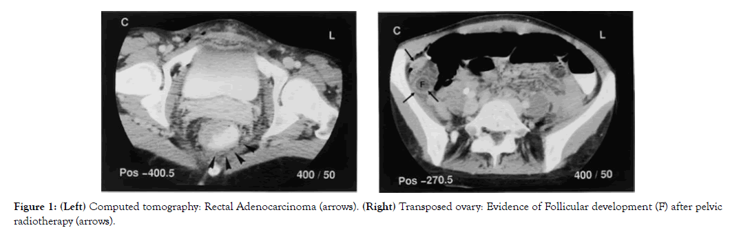 fertilization-rectal-adenocarcinoma