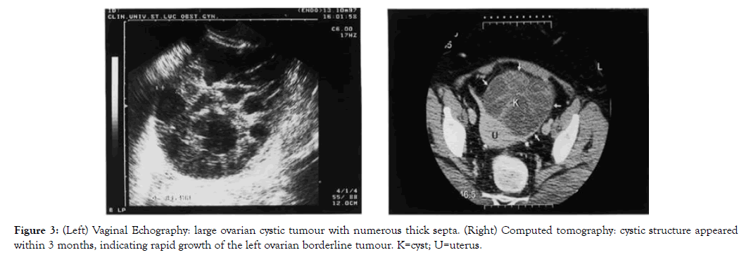 fertilization-vaginal-echography