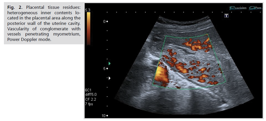 ginekologia-placental-tissue