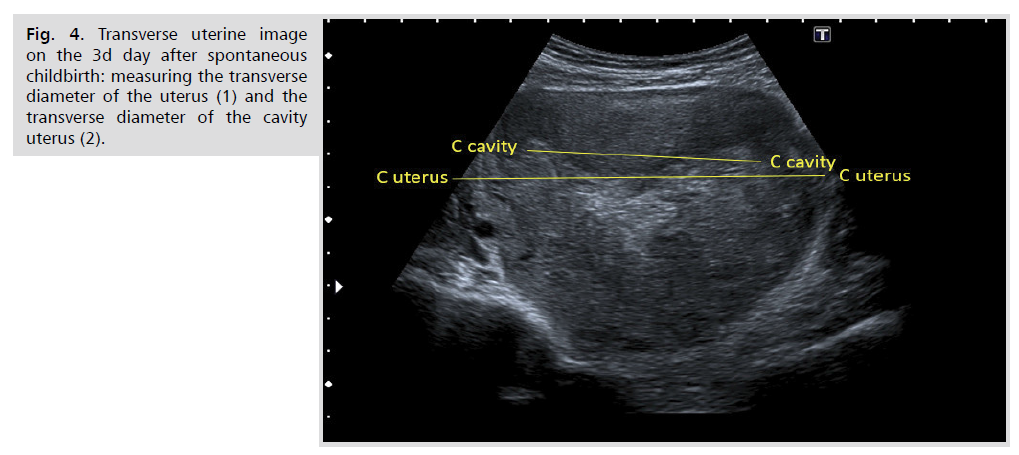 ginekologia-transverse-uterine