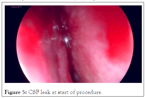 internal-csf-leak