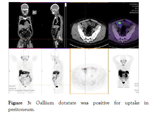 internal-medicine-peritoneum