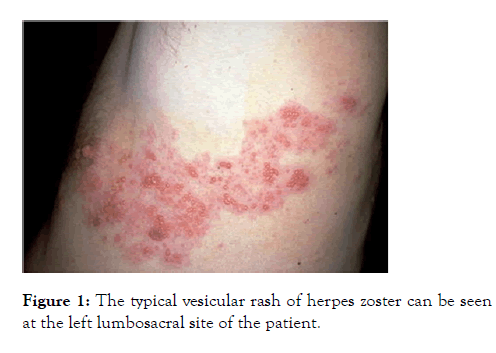 internal-medicine-vesicular