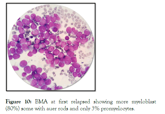 leukemia-auer