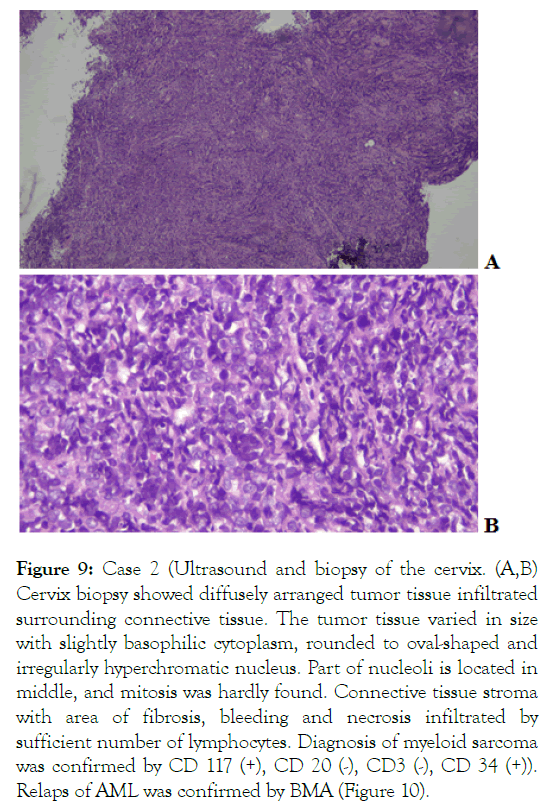 leukemia-biopsy