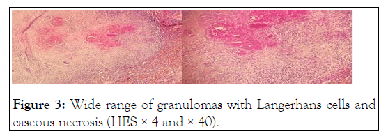 leukemia-granulomas