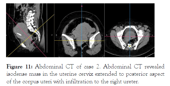 leukemia-isodense