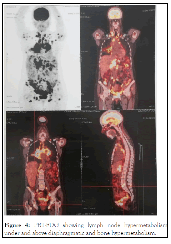 leukemia-lymph