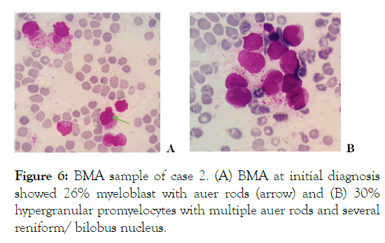 leukemia-myeloblast