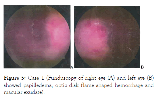 leukemia-papilledema