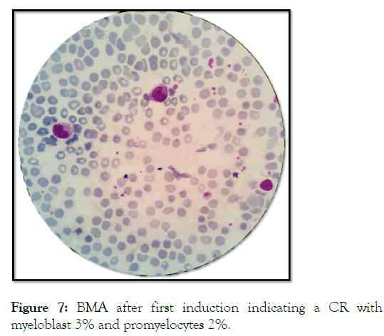 leukemia-promyelocytes