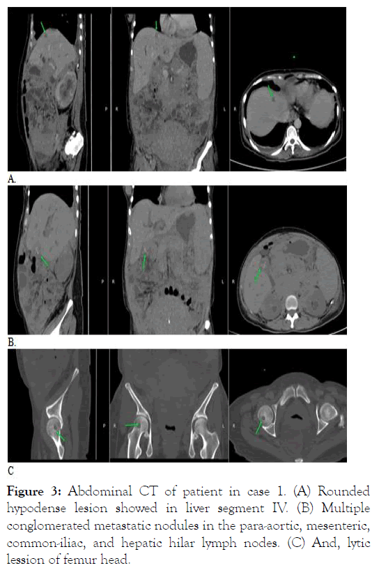 leukemia-segment