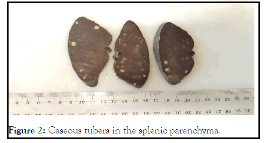 leukemia-splenic