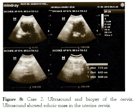 leukemia-uterine