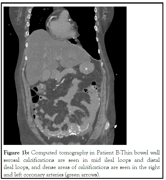 lupus-tomography