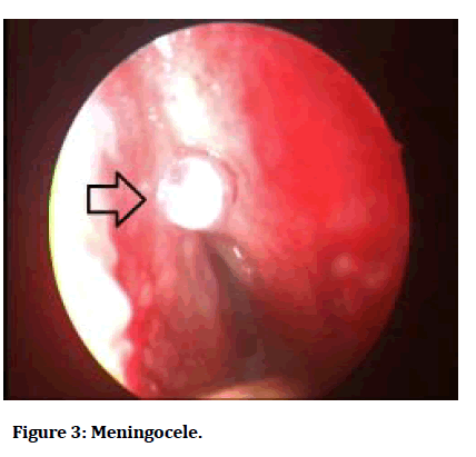 medical-dental-Meningocele